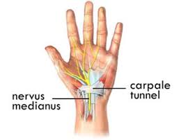 Carpaal Tunnel Syndroom (CTS) is een zenuwbeklemming in de hand.