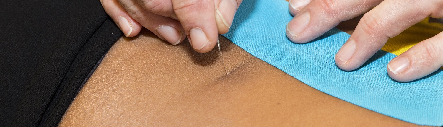 Dry Needling - Chiropractie Praktijk Vividus - Vividus centrum voor gezondheid, van Millenstraat 8 5913 VL Venlo