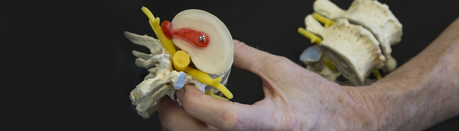 Hernia - Chiropractie Praktijk Vividus - Vividus centrum voor gezondheid, van Millenstraat 8 5913 VL Venlo